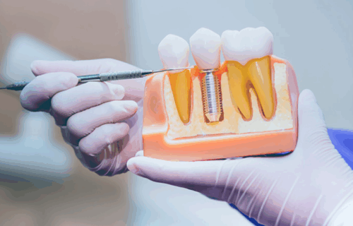 İmplantoloji ve Güncel Yaklaşımları